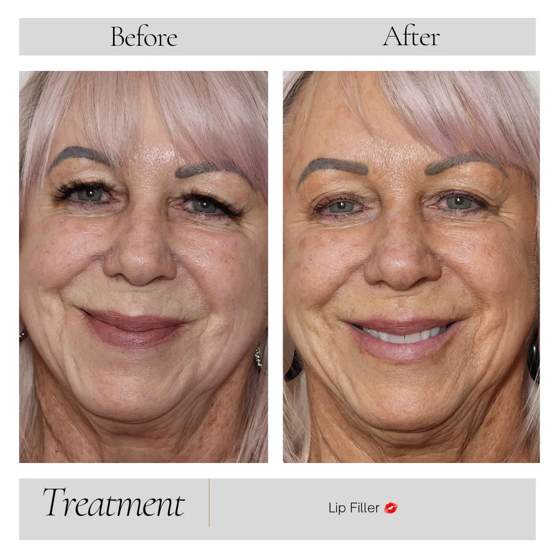 Botox in Kansas City, MO