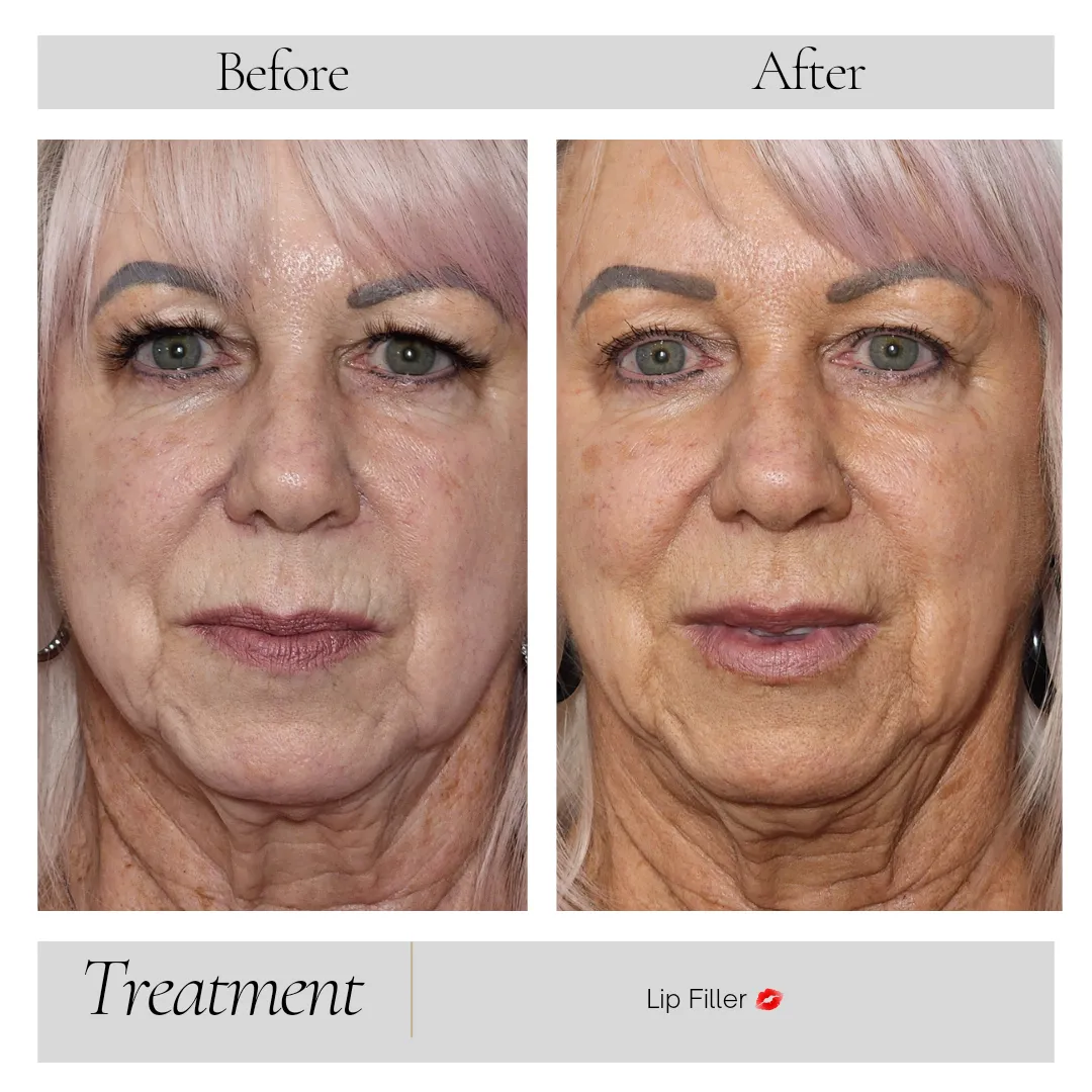 Facial Balancing in Kansas City, MO