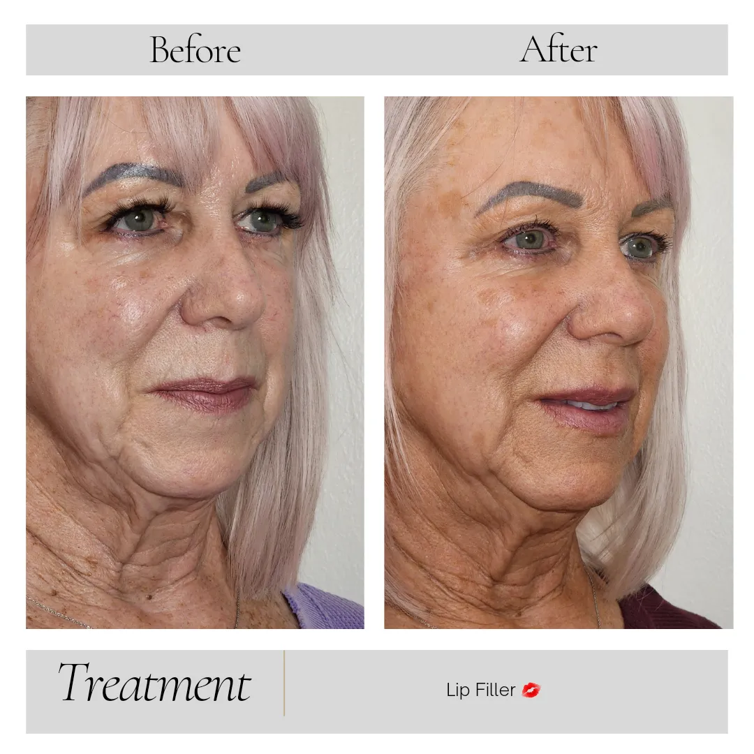 Dermal Fillers in Kansas City, MO