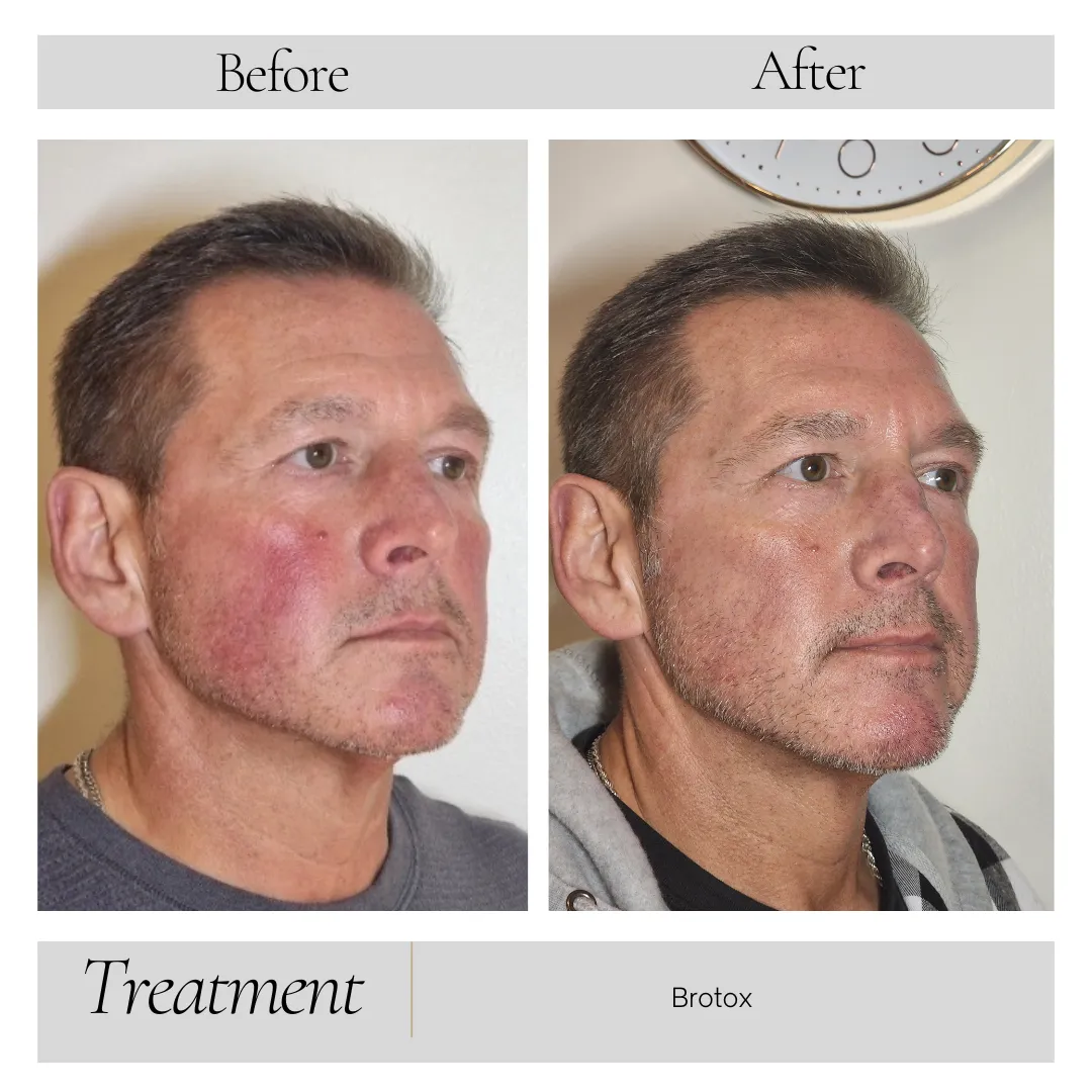 Dermal Fillers in Kansas City, MO