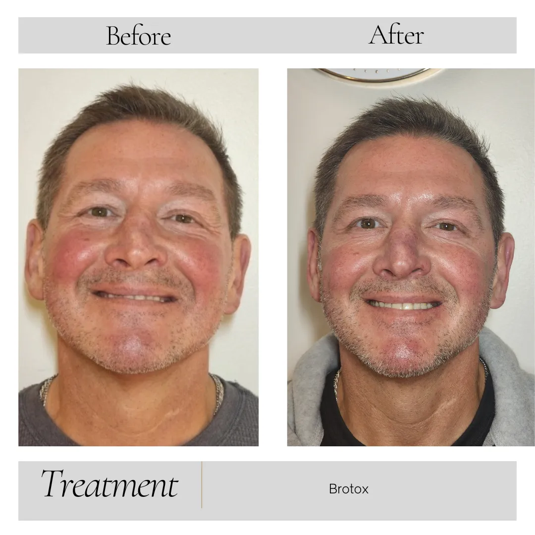 Botox in Kansas City, MO