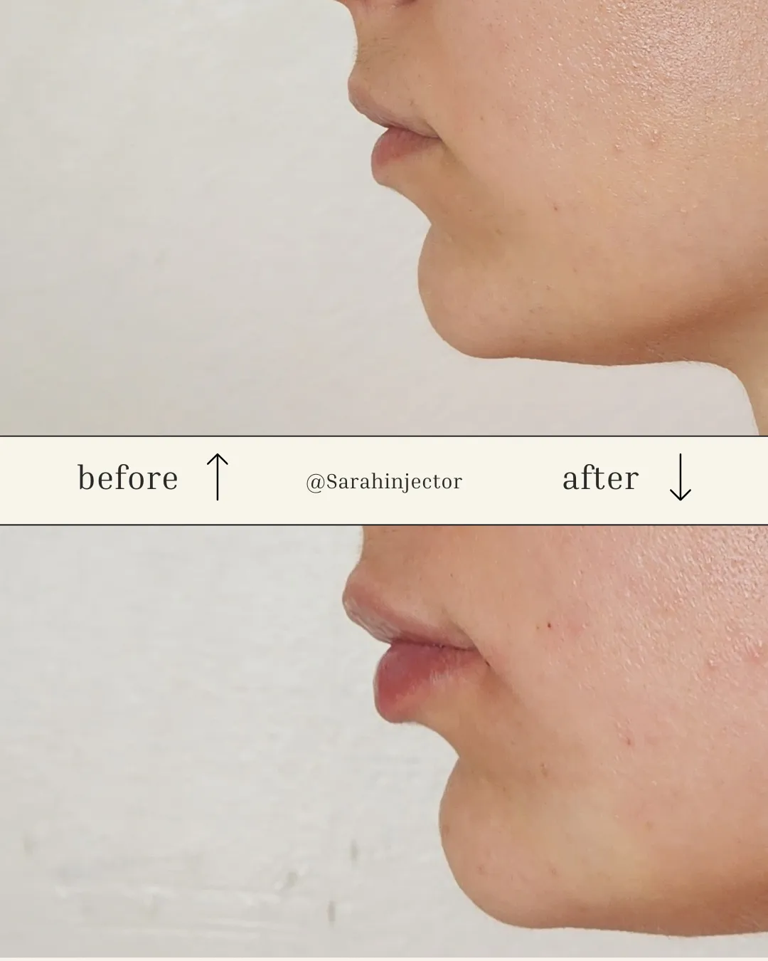Dermal Fillers in Kansas City, MO