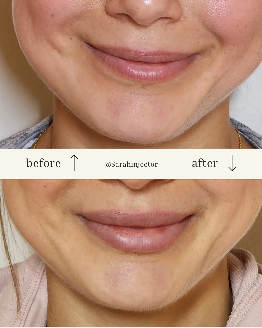 Botox in Kansas City, MO