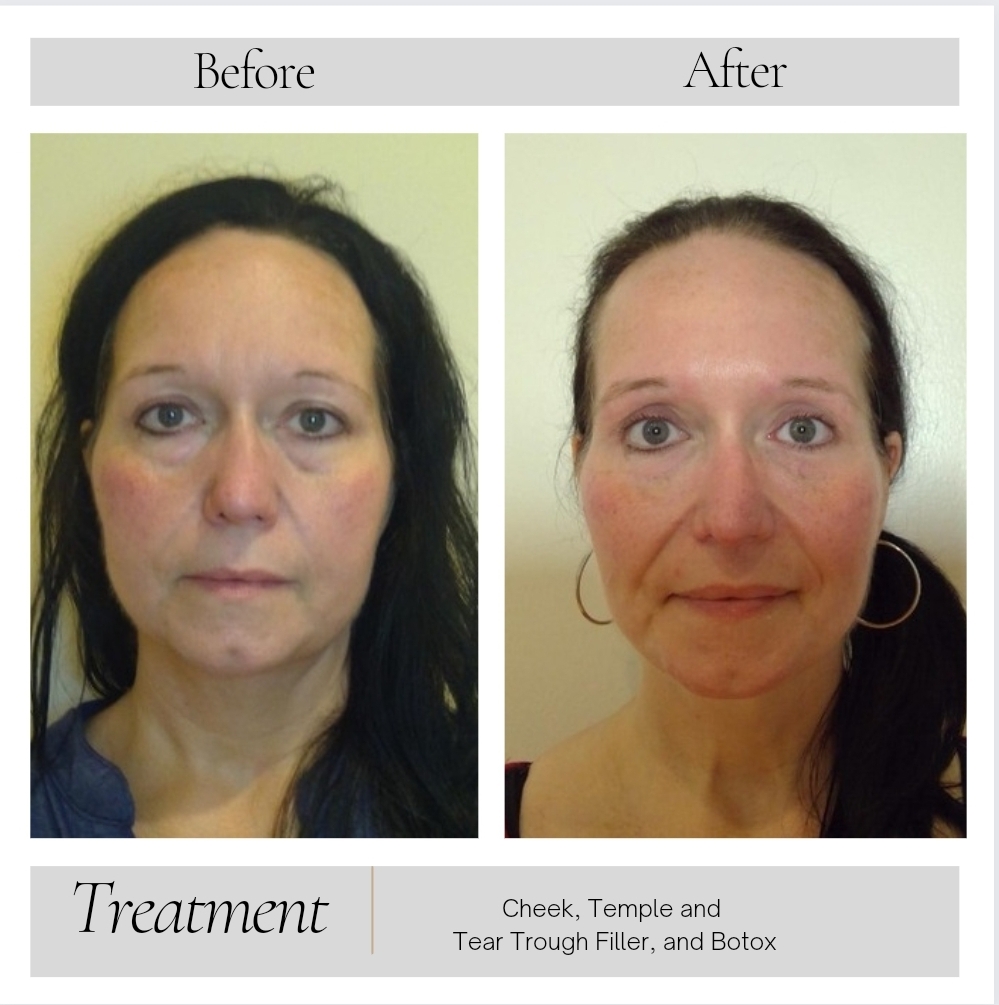 Dermal Fillers in Kansas City, MO
