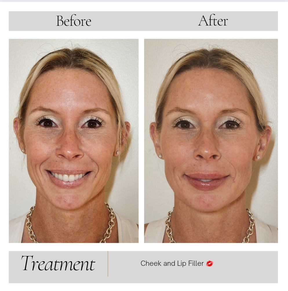 Botox in Kansas City, MO