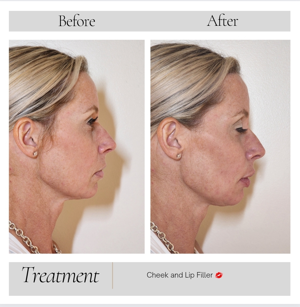 Dermal Fillers in Kansas City, MO