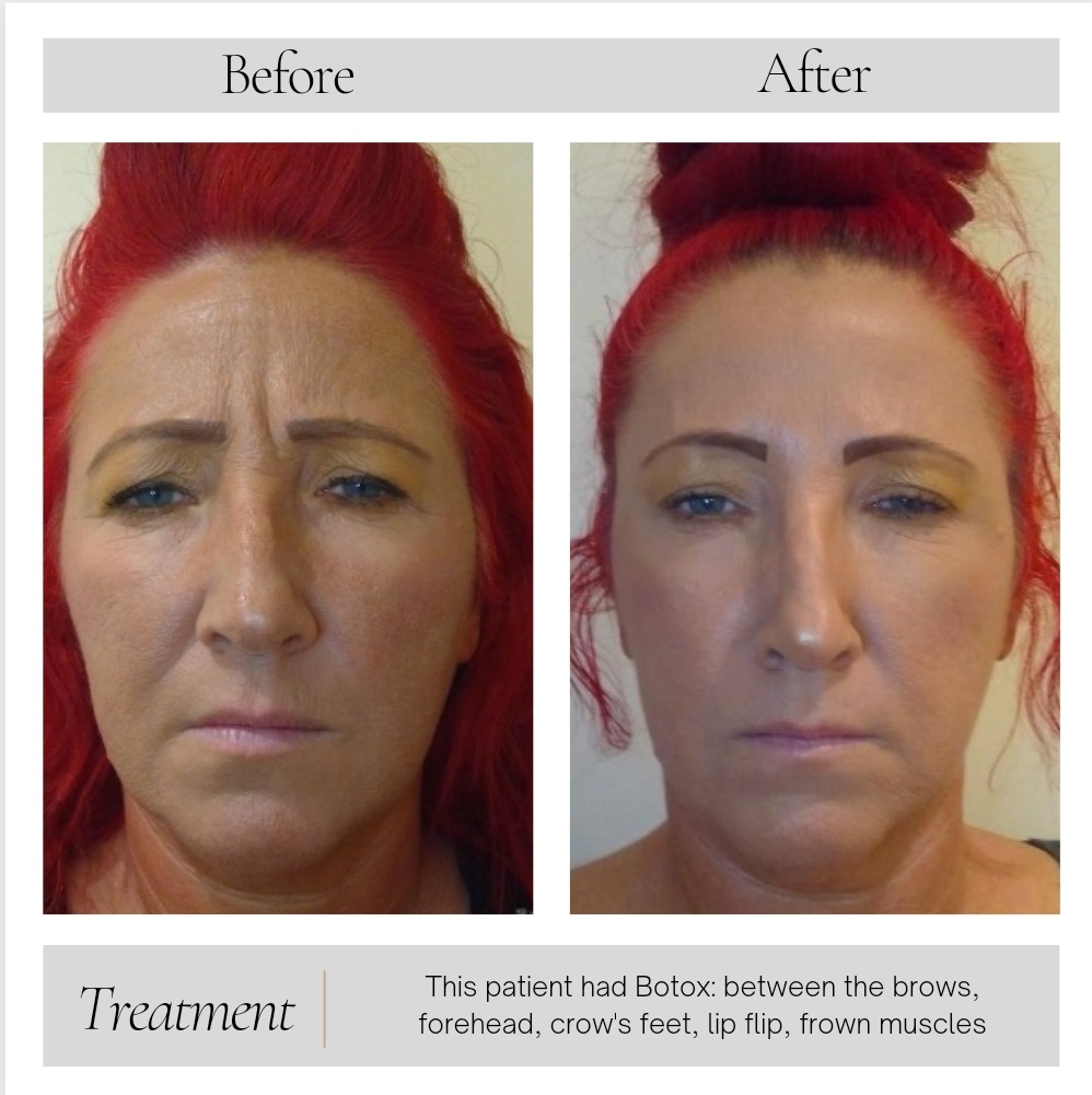 Dermal Fillers in Kansas City, MO