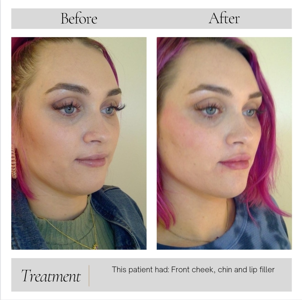 Facial Balancing in Kansas City, MO