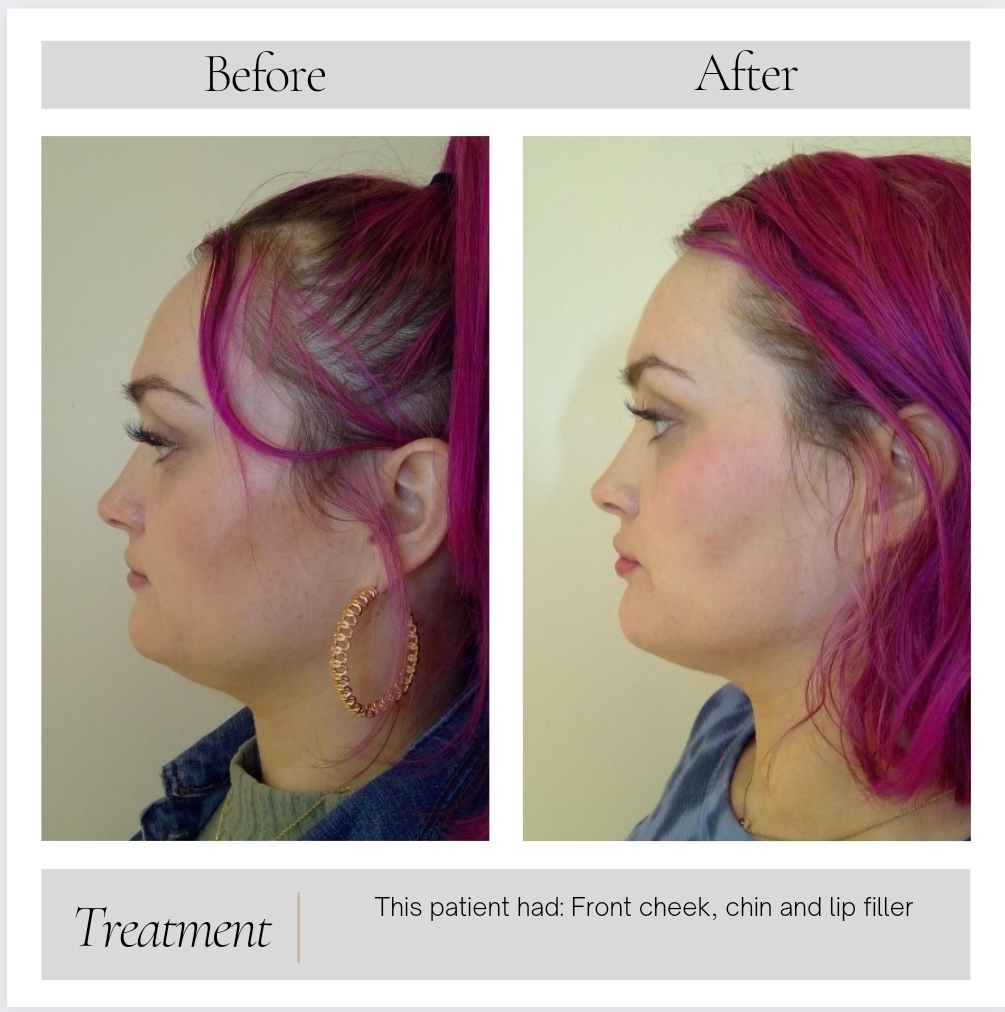 Dermal Fillers in Kansas City, MO