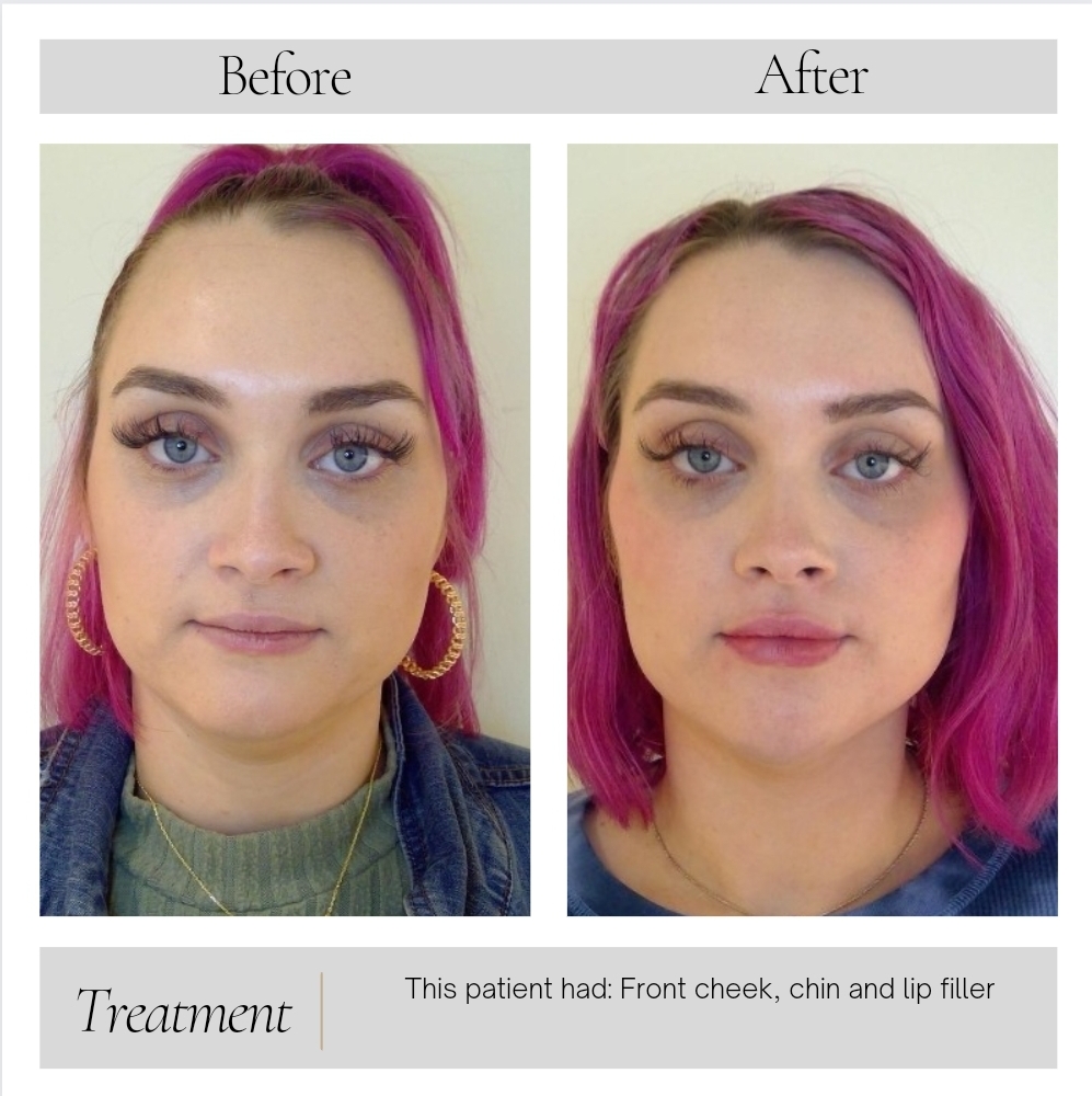 Botox in Kansas City, MO