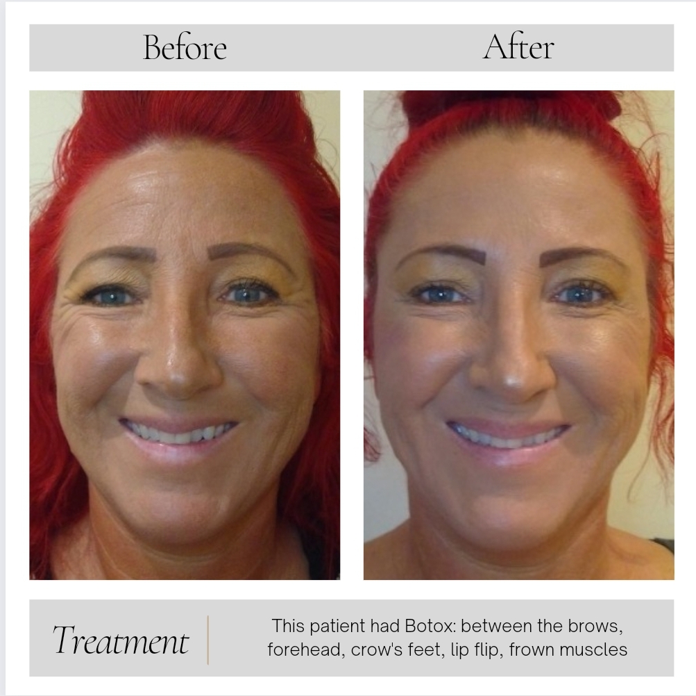 Botox in Kansas City, MO