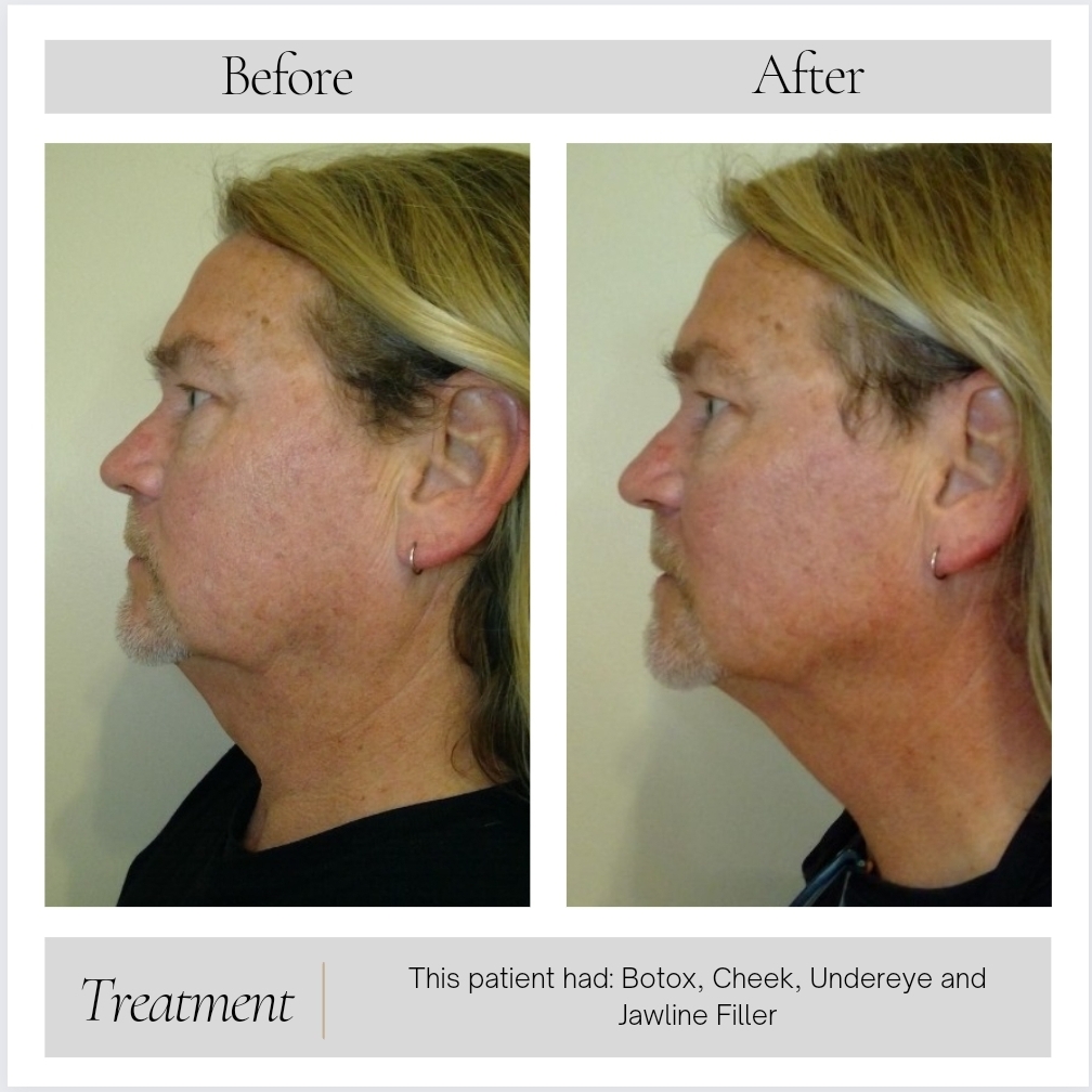 Facial Balancing in Kansas City, MO