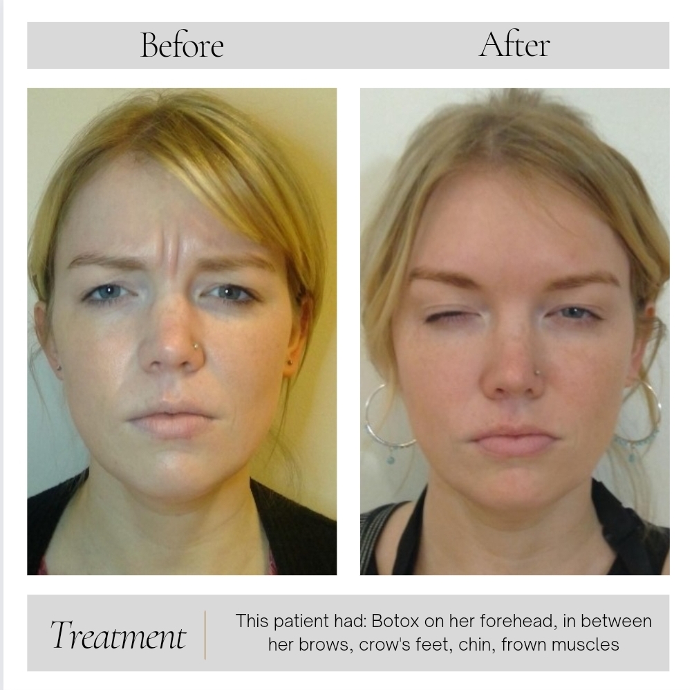 Dermal Fillers in Kansas City, MO