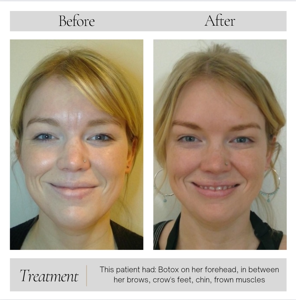 Botox in Kansas City, MO