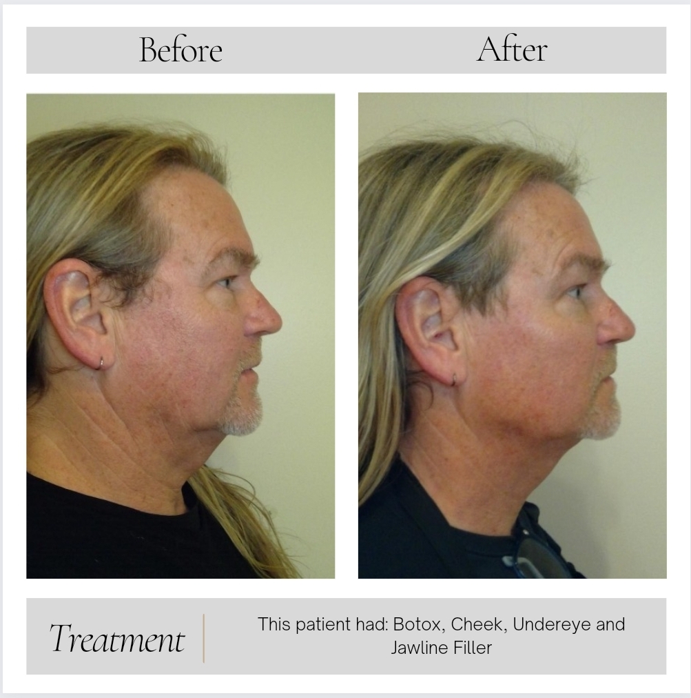 Dermal Fillers in Kansas City, MO