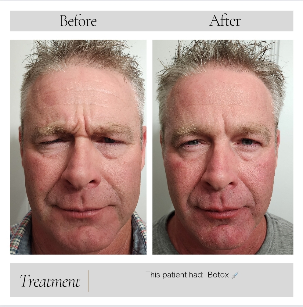 Dermal Fillers in Kansas City, MO