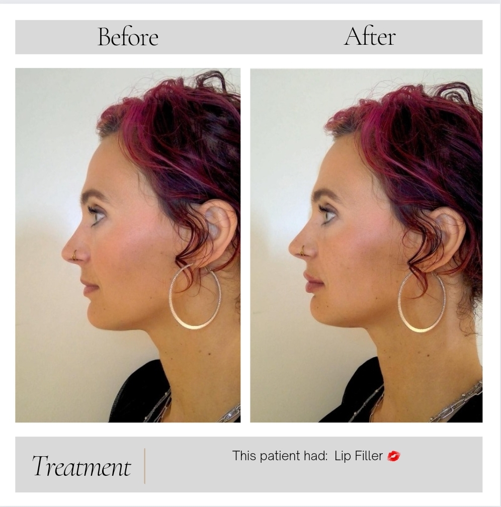 Dermal Fillers in Kansas City, MO