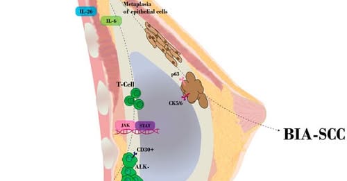 BIA-ALCL and BIA-SCC