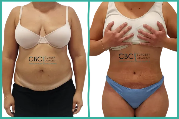 📝 Abdominoplastia de Alta Definición y Reparación de Diástasis Severa: El Reto del "Neo-Ombligo"
