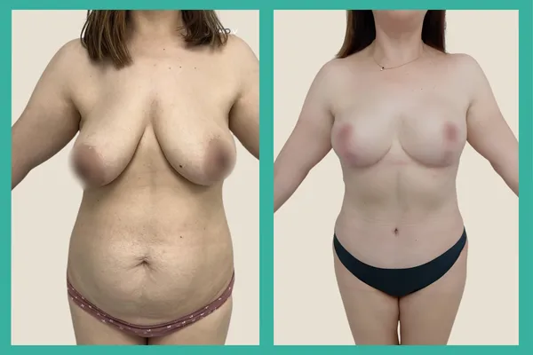 Caso clínico Mommy Makeover — Abdominoplastia sin drenajes, liposucción 360° y reducción mamaria con implantes Eurosilicone 810N 350cc. Resultado a 6 meses. CBC Surgery Academy, Torremolinos Málaga.
