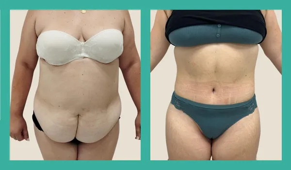 Abdominoplastia ampliada con liposucción de abdomen, cintura y espalda. Corrección de diástasis severa de rectos. Preparación nutricional preoperatoria 6 meses. CBC Surgery Academy, Torremolinos Málaga.