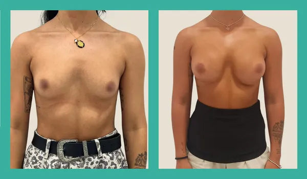 Caso 13189 — Aumento de pecho con implantes ergonómicos Motiva ERSF 295cc en mamas tuberosas. Abordaje vía surco submamario. Resultado a 6 meses. CBC Surgery Academy, Torremolinos Málaga.