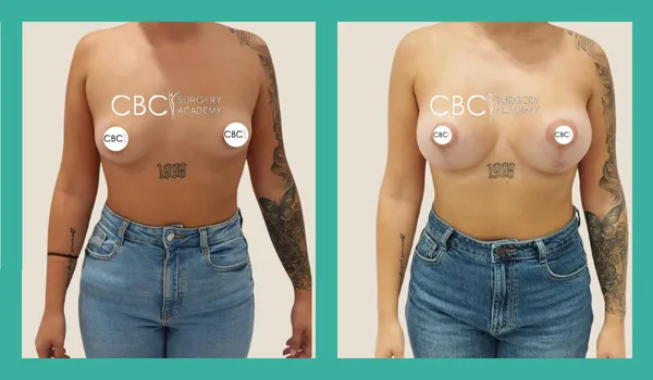 Mastopexia Periareolar y Vertical con Implantes Motiva en Paciente con Mamas Tuberosas — Caso Ref. 14158