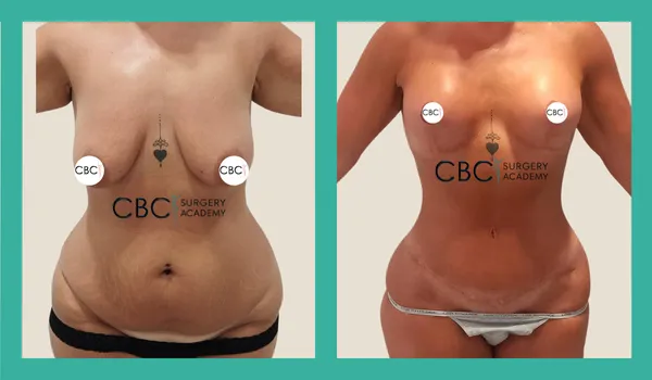 Reducción Mamaria con Implantes Ergonómicos y Abdominoplastia tras Pérdida Masiva de Peso: Manejo de Expectativas y Cirugía de Revisión Ambulatoria— Ref. 13064
