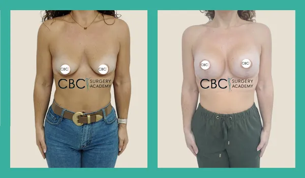 Mastopexia Vertical con Implantes Ergonómicos y Revisión de Asimetría: Gestionar la Percepción del Resultado — Caso Ref. 12082