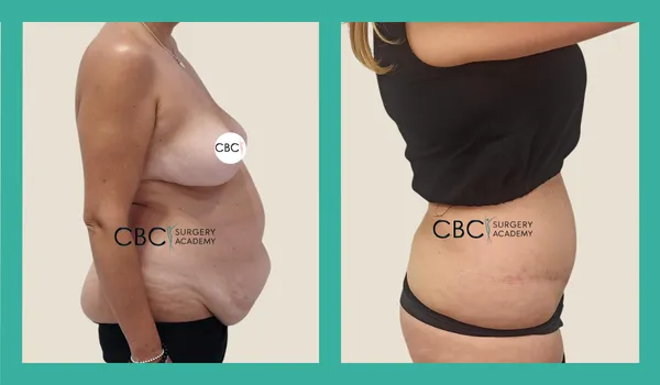 Mommy Makeover con diástasis severa: abdominoplastia, liposucción de espalda y reducción mamaria con implantes