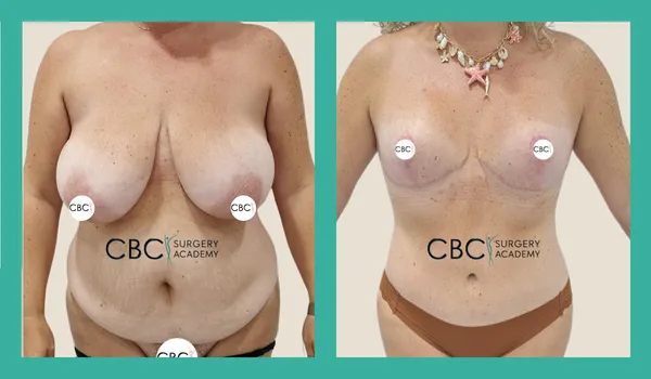 Abdominoplastia, Liposucción de Espalda, Herniorrafia Umbilical y Reducción Mamaria con Implantes — Preparación Nutricional y Cirugía Combinada en un Único Tiempo — Caso Ref. 11471
