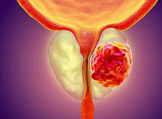 prostate issue