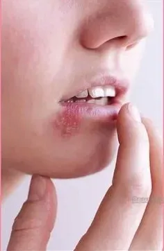 herpafend for herpes