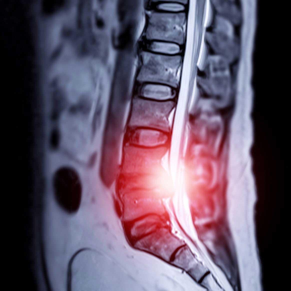 X-Ray image of spinal compression