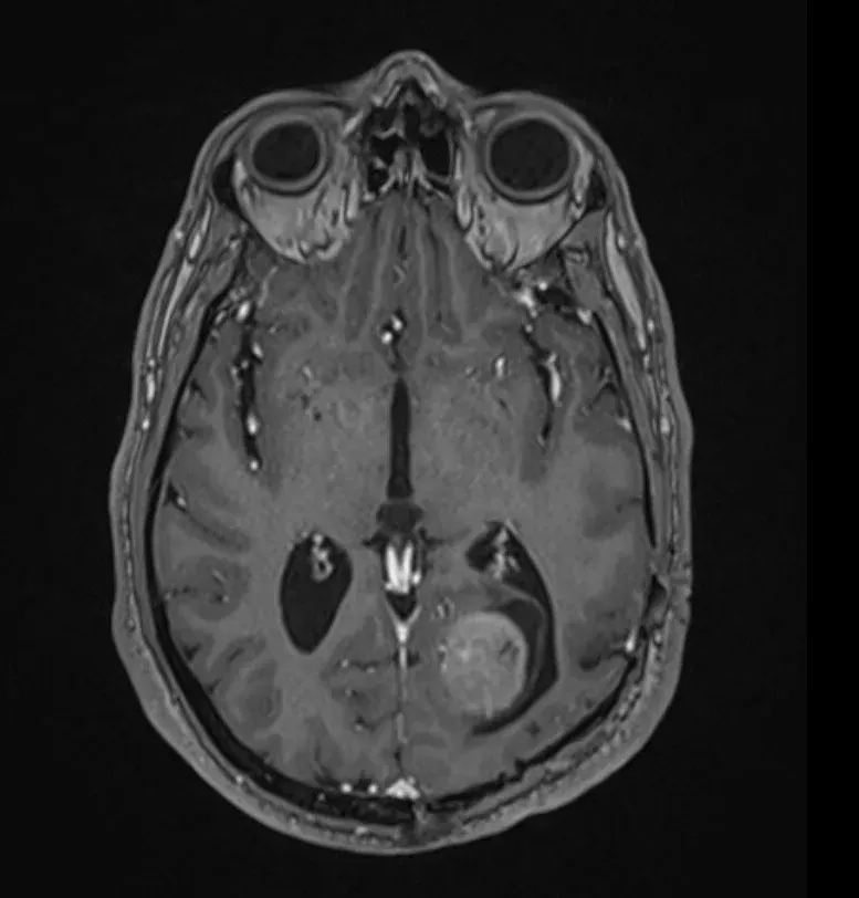 opened amber glass vial bottle