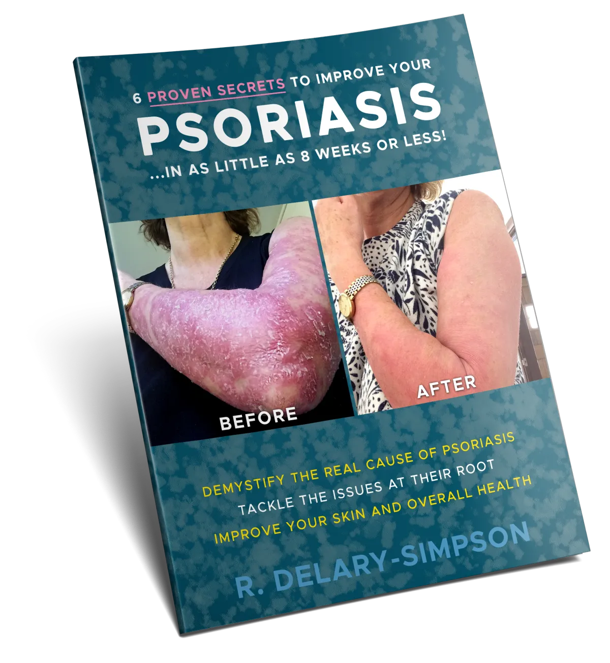 Improve Psoriasis Guide