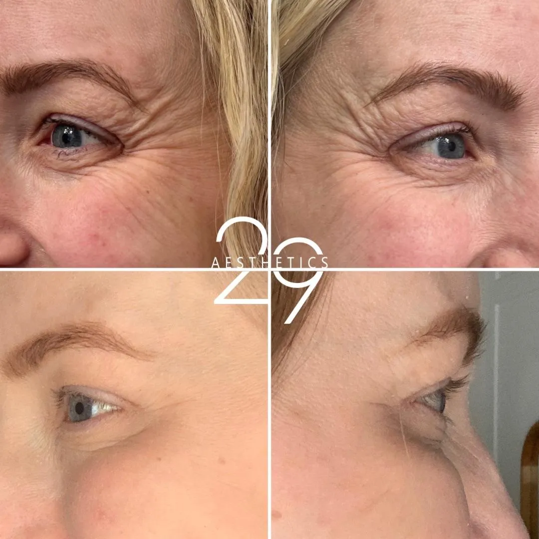 Before and after of lines around the eyes. Wrinkle treatment of crow's feet.