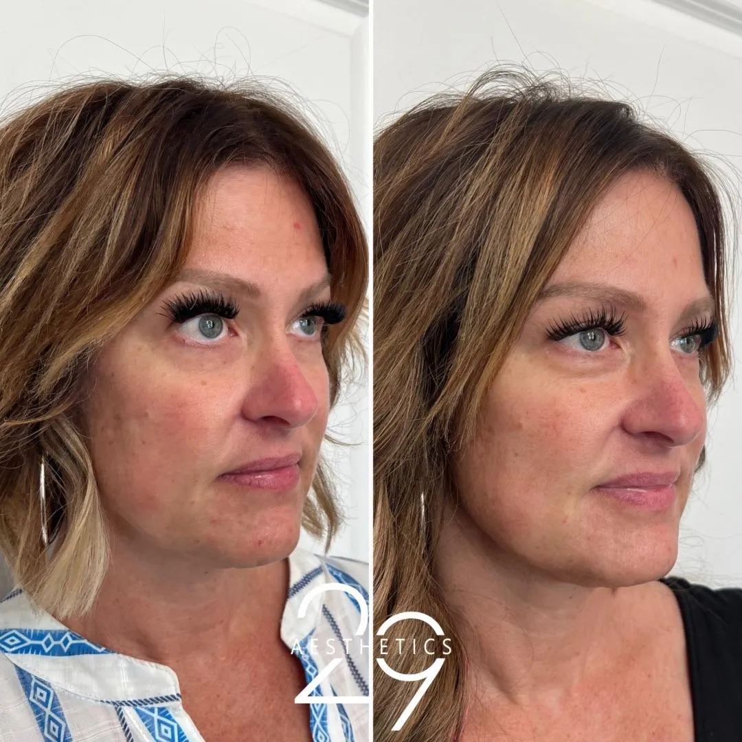 Before and after photos of the face following Sculptra treatment.