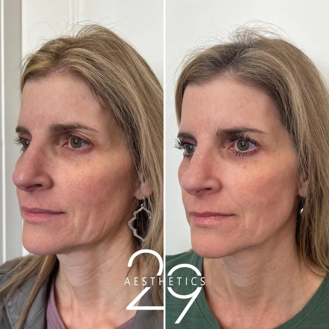 Woman's before and after photos of face results following collagen biostimulator treatment. Smooth away lines and wrinkles.