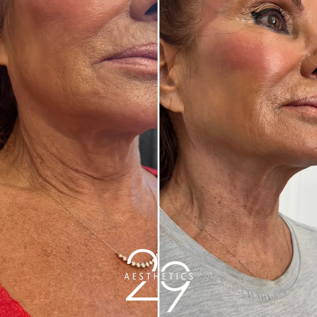 Image of neck after treatment. Hyperdilute Radiesse used on the neck to smooth away lines and wrinkles. Before and after.