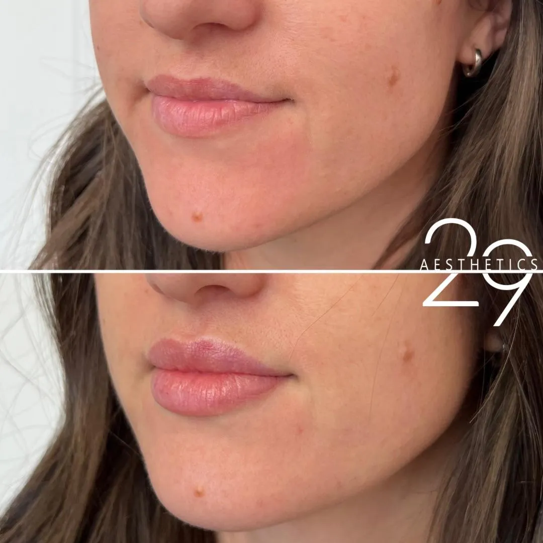 Lip filler before and after. Treatment results.