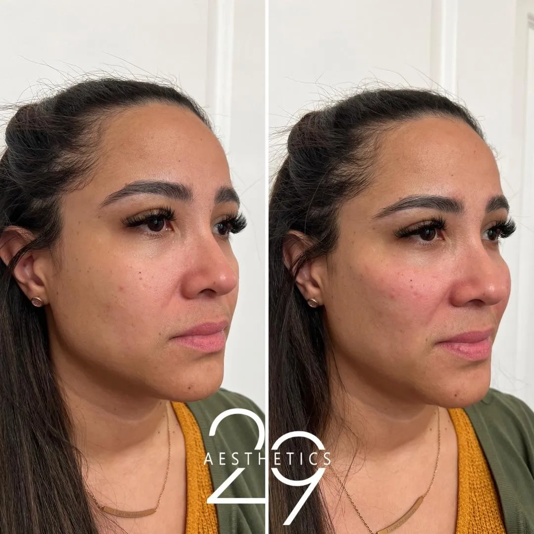 Cheek filler before and after photos.