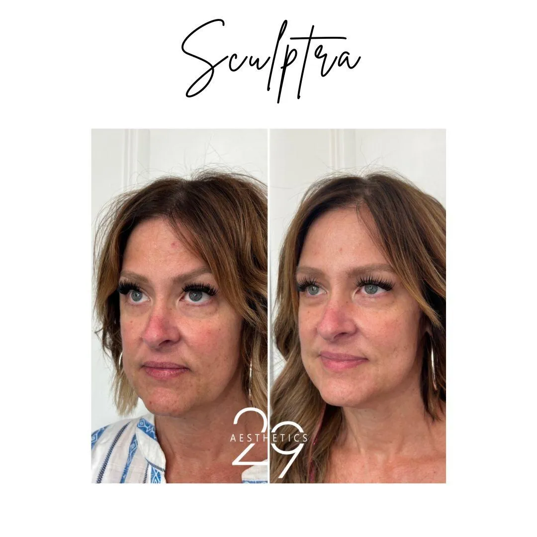 Before and after images of woman following Sculptra treatment.