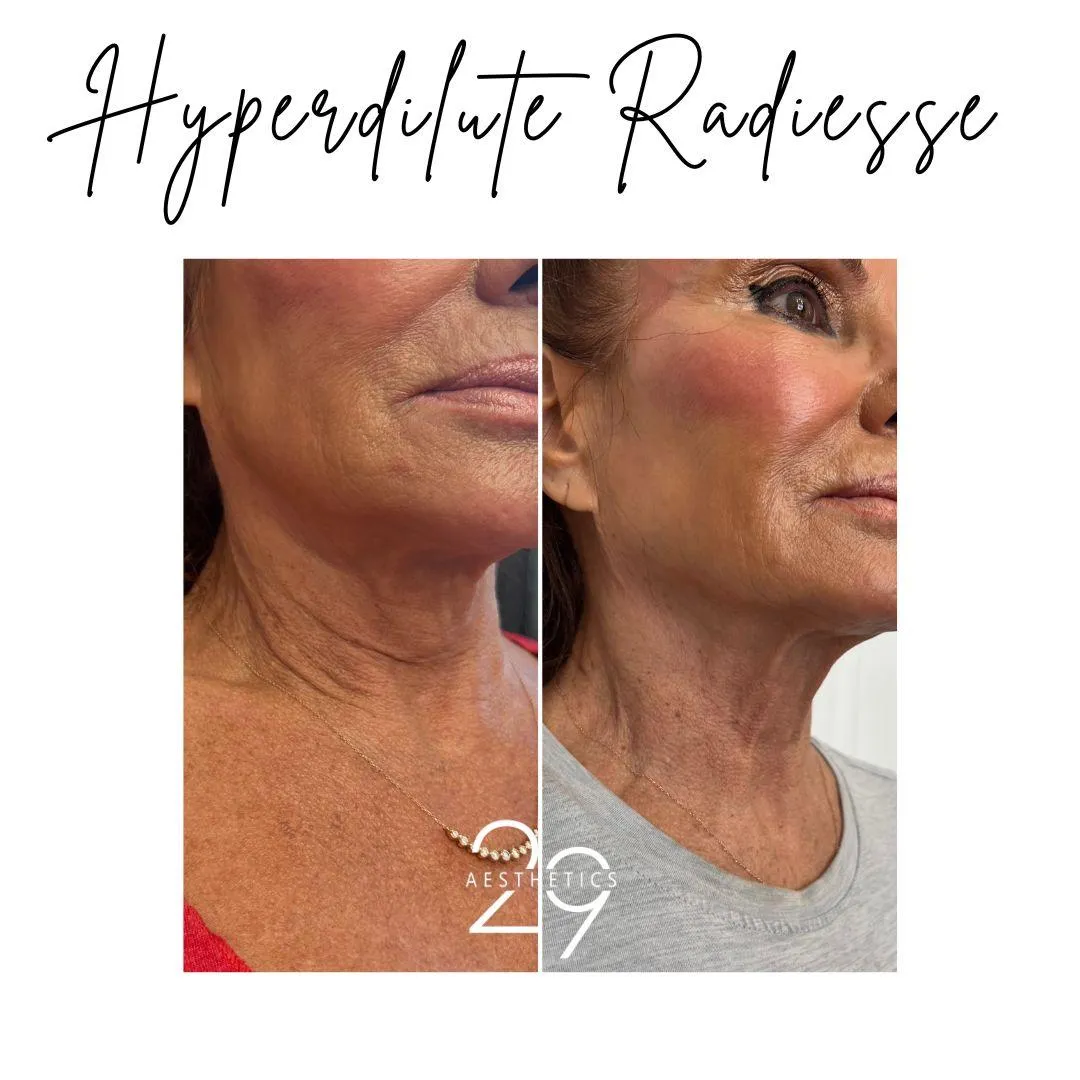 Hyperdilute Radiesse before and after images of the neck.