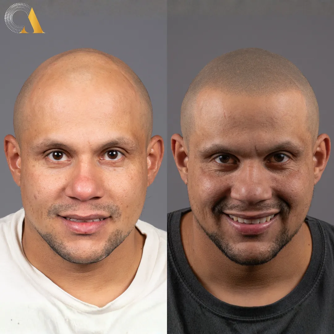 Antes y después micropigmentación capilar — caso real 2