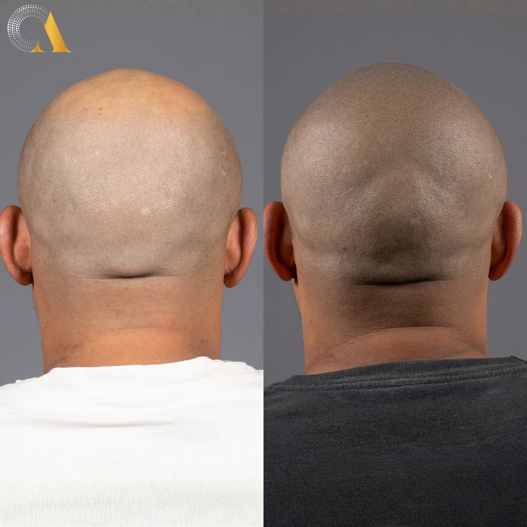 Antes y después micropigmentación capilar — caso real 1