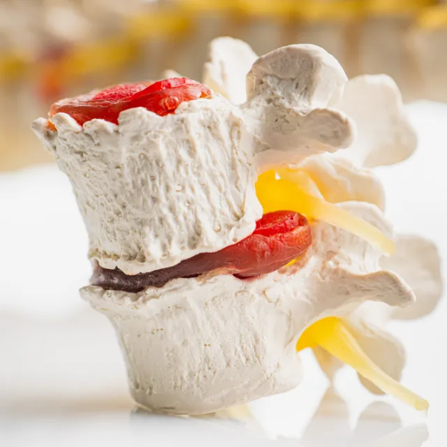 Spinal model showing degenerative disc issues treated with decompression