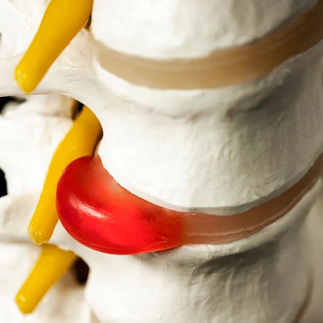 Medical illustration of herniated disc representing treatment at Plano chiropractic clinic
