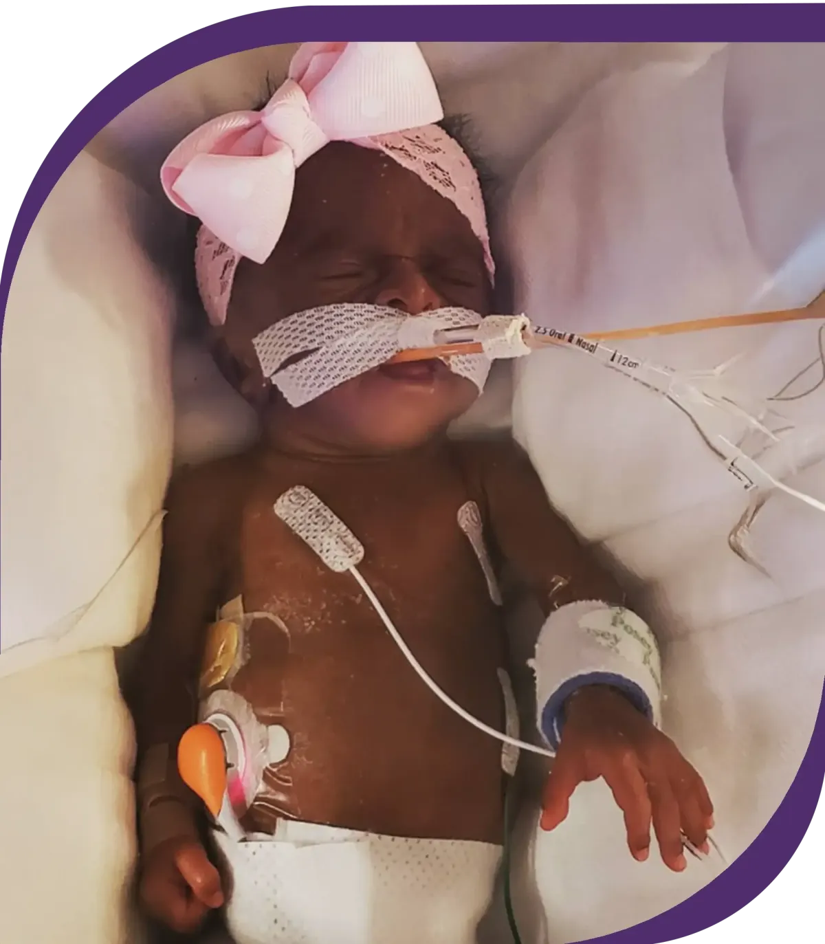 Prolacta Baby Kallie | Born 24 weeks | Birth weight 13.1 oz | Days in the NICU 150