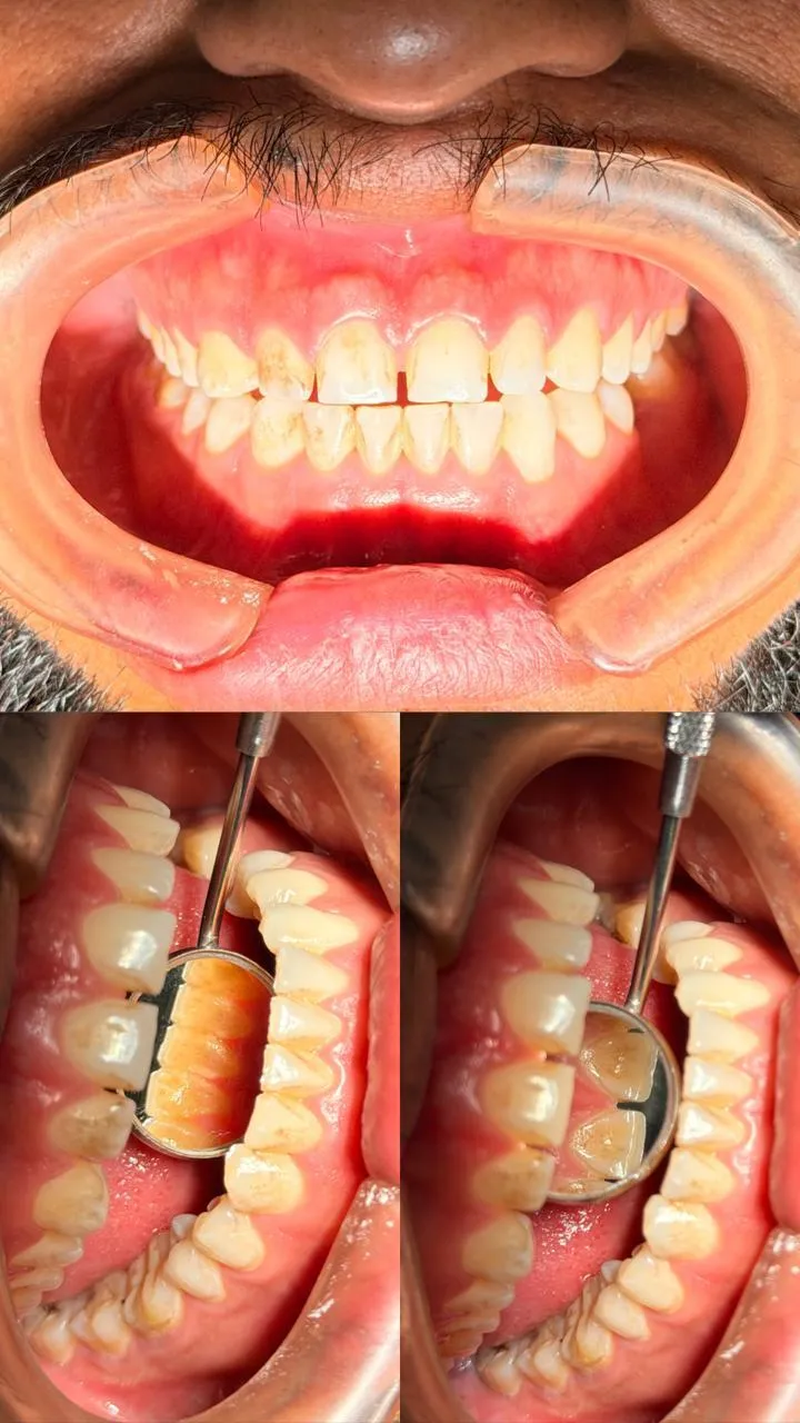 Resultado de paciente - Lipoescultura